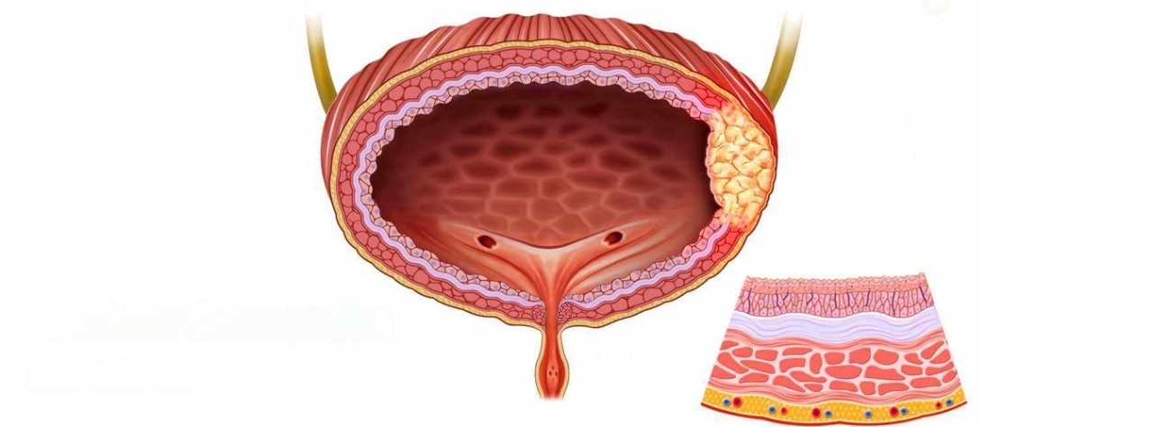 Bladder Cancer: An overview