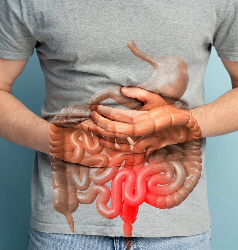Colorectal Cancer