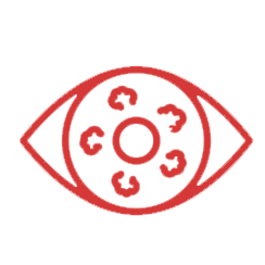 Retinoblastoma